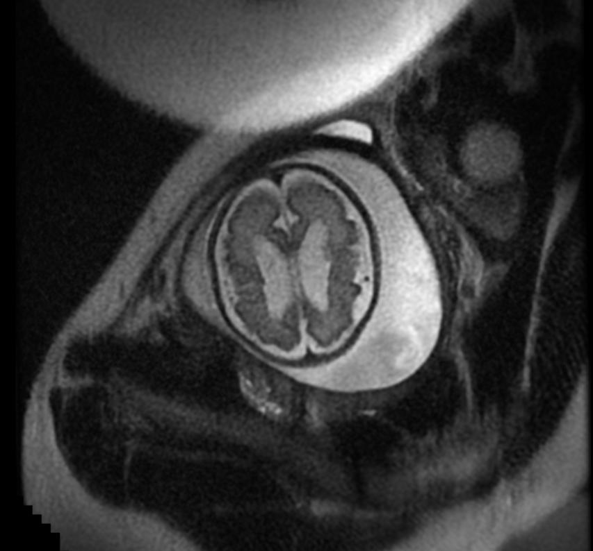 Fetal MRI: Aqueductal stenosis