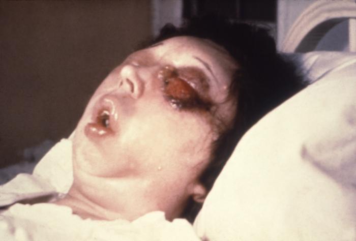 "Female patient shown here on the 5th day of a Bacillus anthracis infection involving her left eye.”Adapted from Public Health Image Library (PHIL), Centers for Disease Control and Prevention.[3]