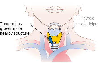 Stage T4a thyroid cancer