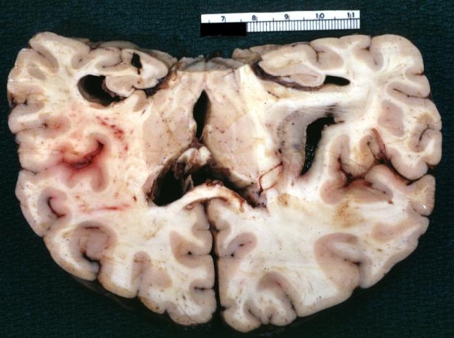 Brain: Oligodendroglioma: Gross; fixed tissue, ischemic tissue, anterior to tumor mass