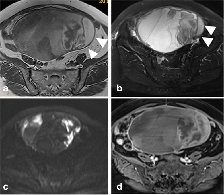 File:Granulosa cell tumor MRI findings.jpg