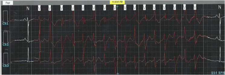 File:Holter monitor tracing.jpg
