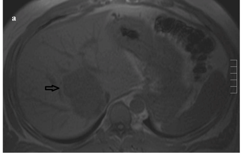 File:Liver-MRI-ZES.png