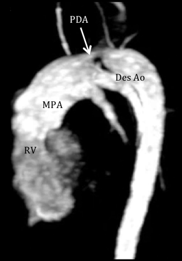 File:MRI demonstrates a patent ductus arteriosus.jpg