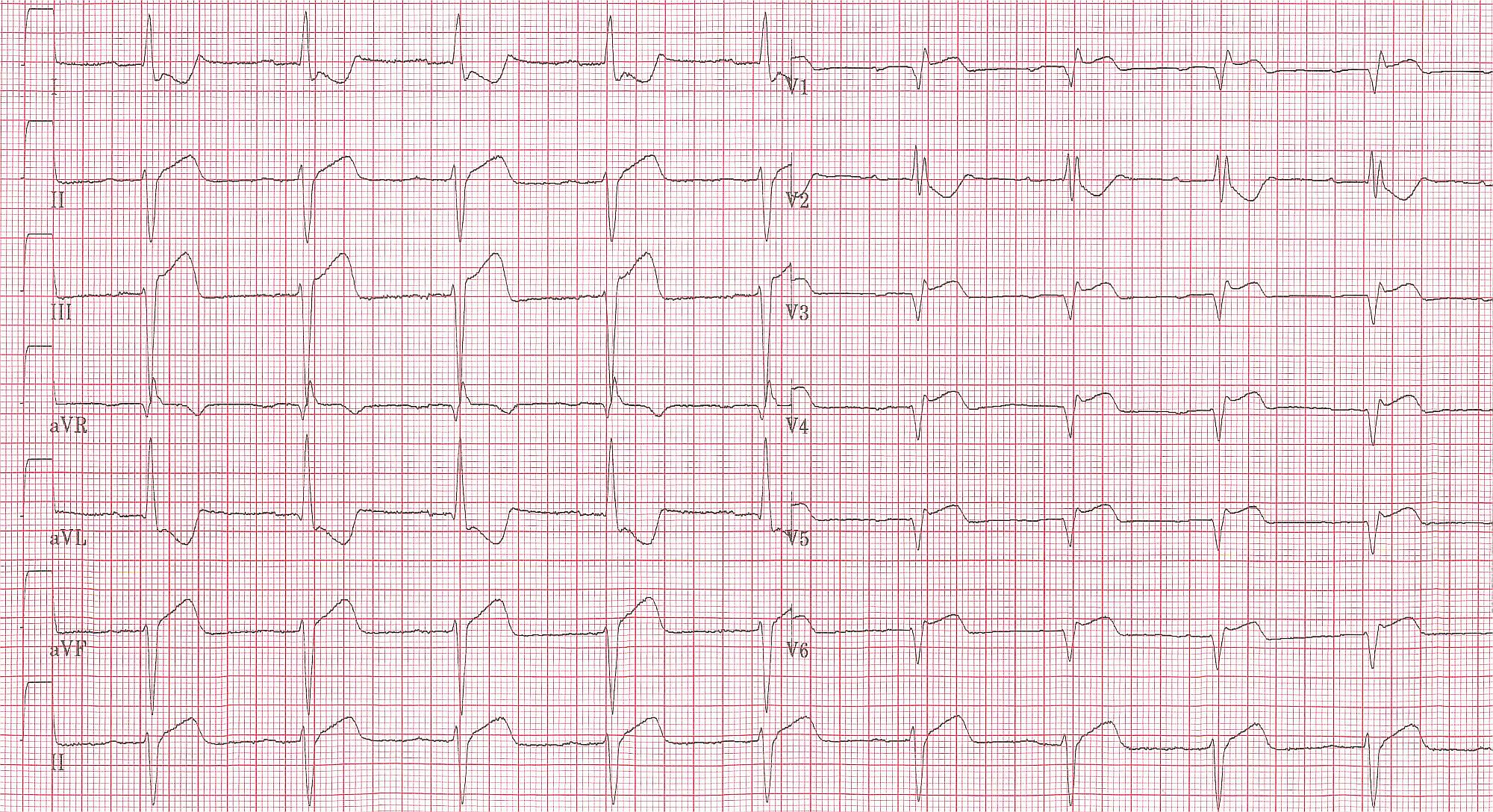 The same patient. Lead V4R. ST elevation shown.