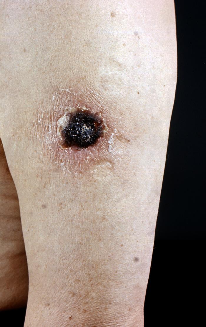 59 year-old male patient developed progressive vaccinia after having received a smallpox vaccination in his left shoulder.Adapted from Public Health Image Library (PHIL), Centers for Disease Control and Prevention.[3]