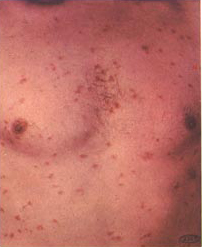 Syphilis lesions on a patient's chest