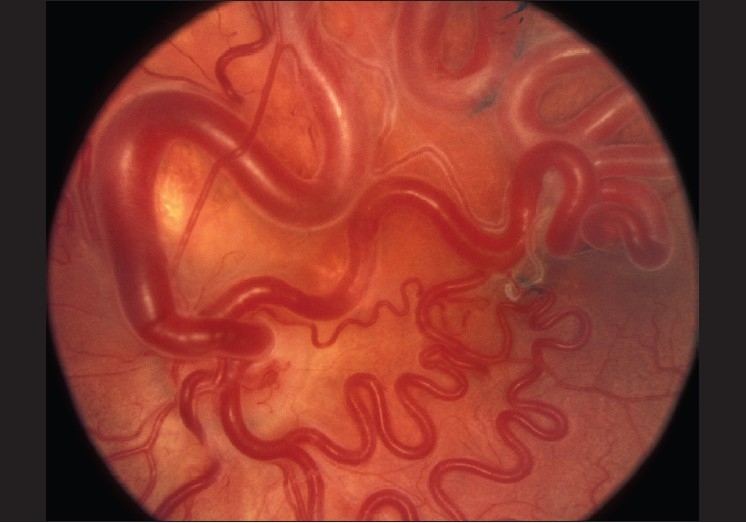 retinal arteriovenous malformation