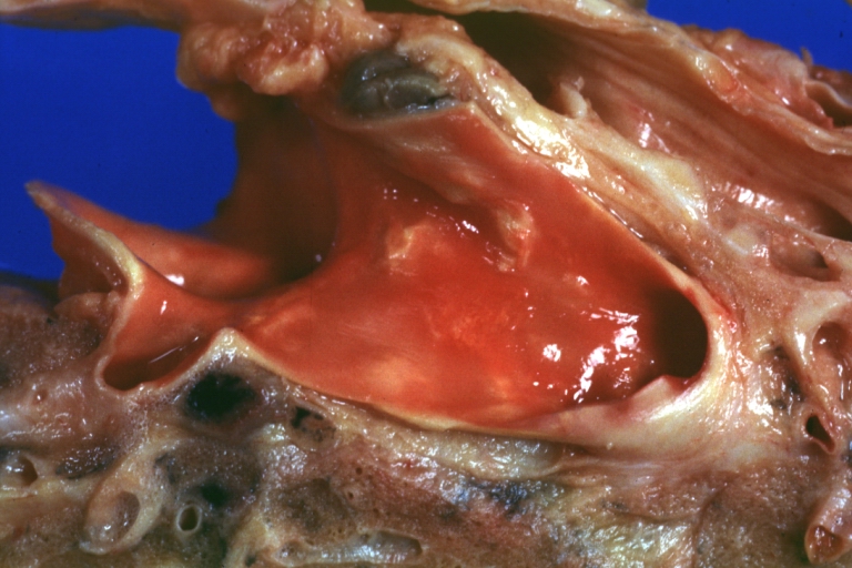 Pulmonary Artery Atherosclerosis: Gross, essentially natural color, artery stained by hemolysis, small plaque lesions