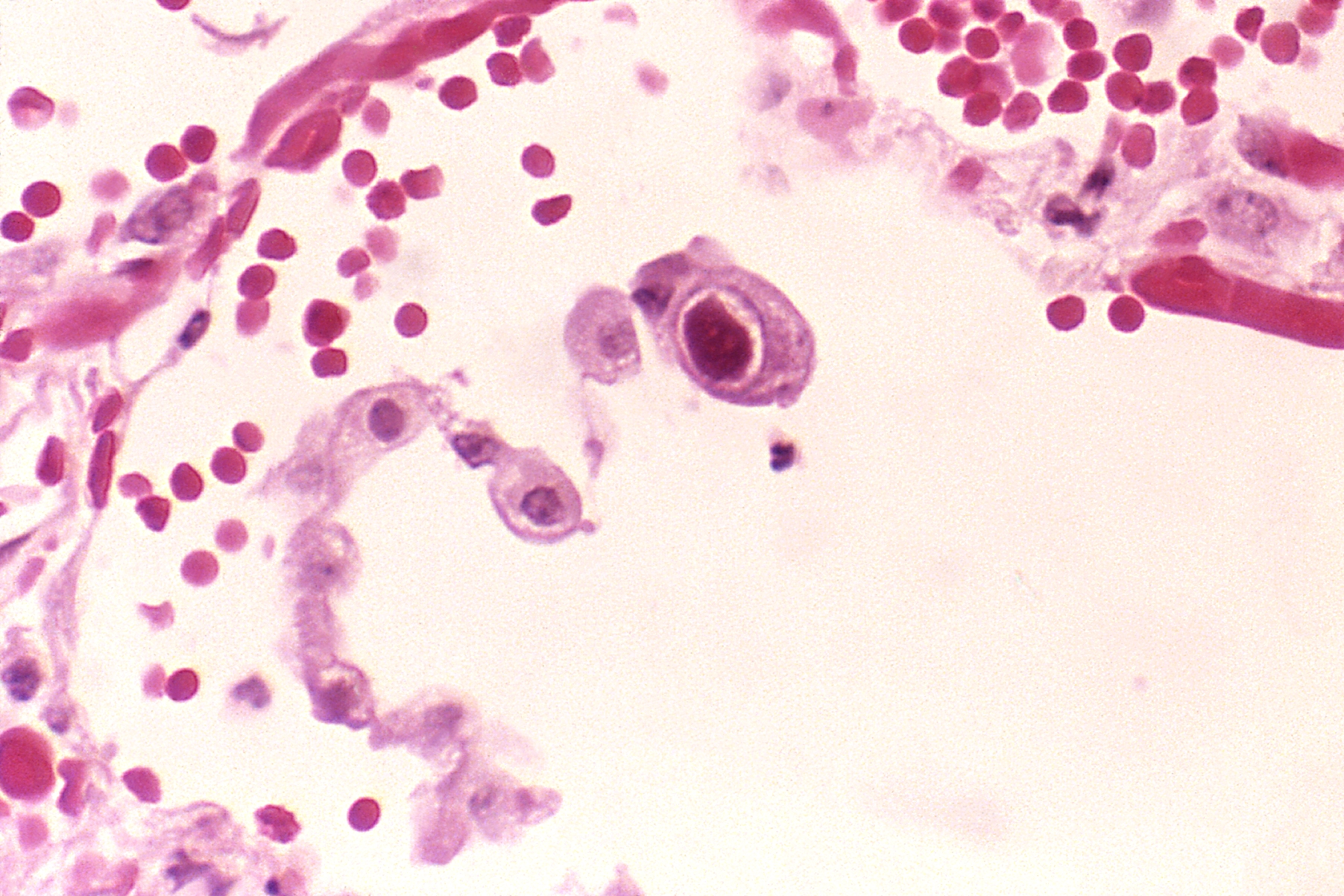 Cytomegalovirus By Transferred from en.wikipedia to_Commons.This_media_comes_from_the_Centers_for_Disease_Control_and_Prevention's_Public_Health_Image_Library_(PHIL),_with_identification_number_-958.Note_Not_all_PHIL_images.