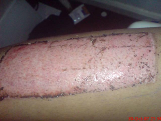 Skin Graft Donor site 8 days after the skin was taken