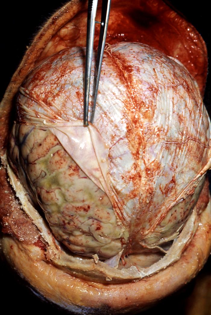 Autopsy photo from the CDC: The white "sheet" being held by the forceps is the dura mater.
