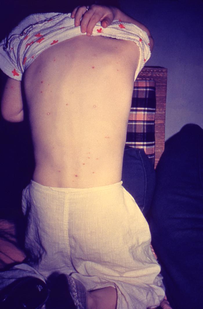 Back of boy who had manifested the maculopapular rash that was determined to be chickenpox, also known as varicella-zoster virus (VZV). From Public Health Image Library (PHIL). [24]