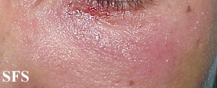 File:Nail polish dermatitis07.jpg