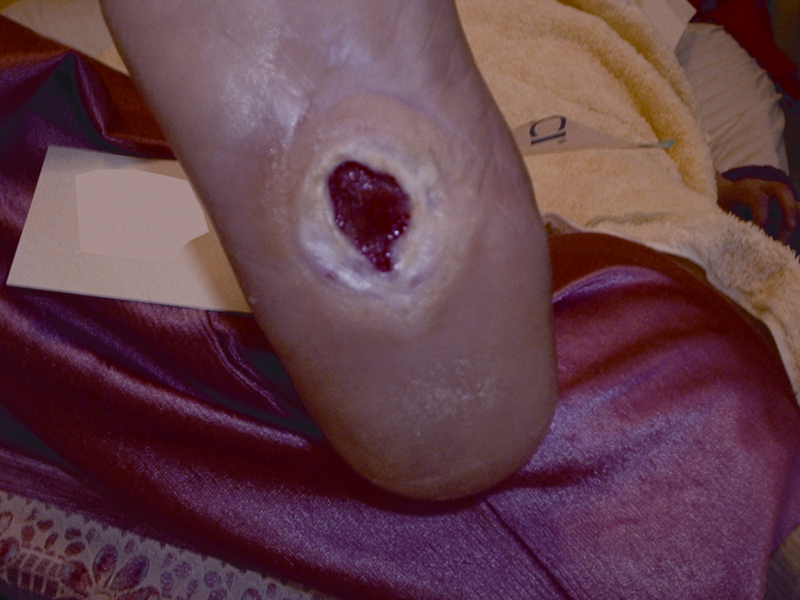 Diabetic foot ulcer prior to treatment