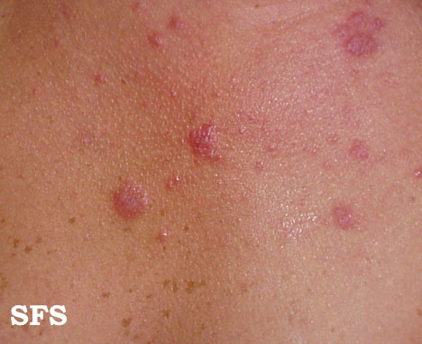Polymorphic light eruption. With permission from Dermatology Atlas.[1]