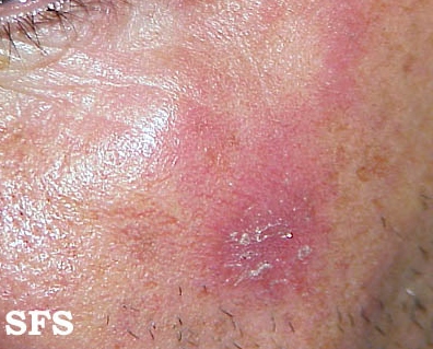 Polymorphic light eruption. Adapted from Dermatology Atlas.[1]