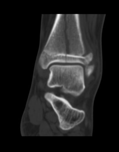 Salter-Harris fracture-IV Image courtesy of RadsWiki and copylefted