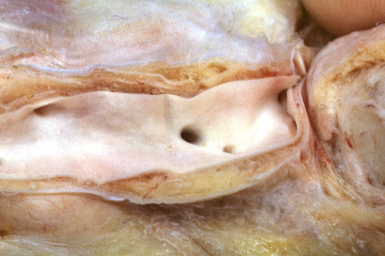 Atherosclerosis: Gross, proximal left anterior descending artery showing faint fatty streaks and penetrating arteries