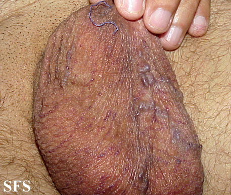 Angiokeratoma Of The Scrotum Adapted from Dermatology Atlas