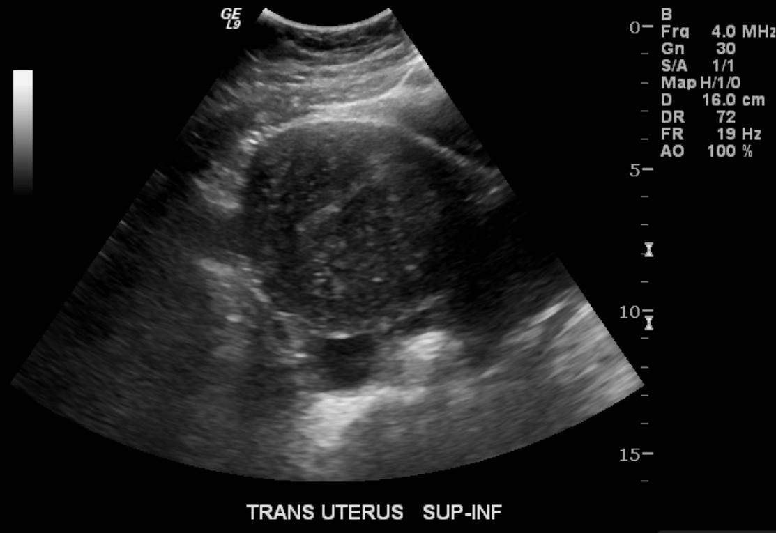 File:Adenomyosis ultrasound 101.jpg