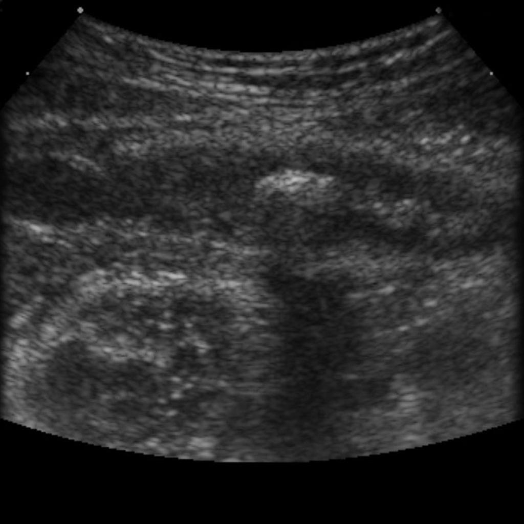 File:Appendicolith-on-ultrasound.jpg