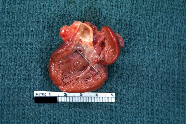 Perimembranous Ventricular Septal Defect: Gross, an excellent example