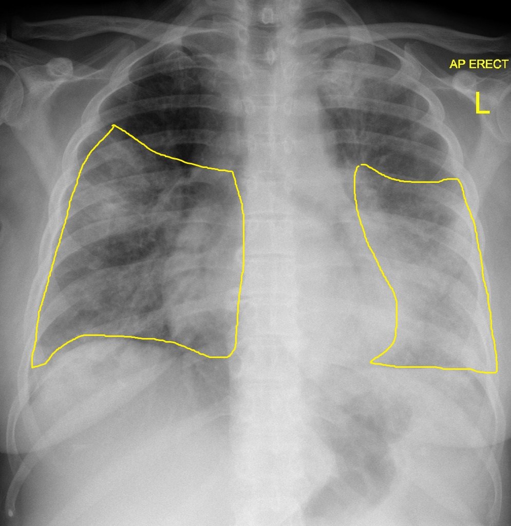 File:Legionella-pneumonia - Case courtesy of Dr Henry Knipe, Radiopaedia.org, rID 31816.jpg
