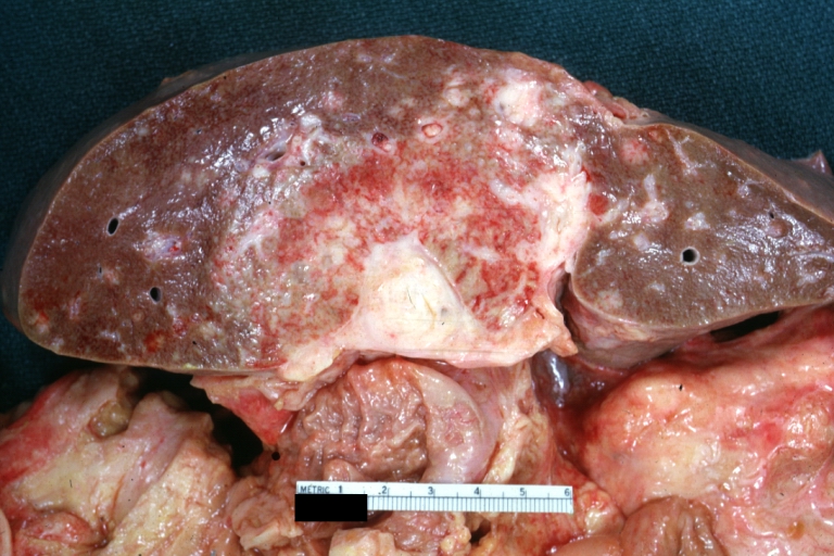 Gallbladder carcinoma: Gross, natural color of slice of liver showing attached gallbladder obliterated by tumor and with tumor invading adjacent liver parenchyma like a sunburst (an excellent example)
