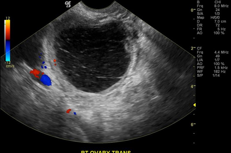 Hemorrhagic ovarian cyst ultrasound 103.jpg