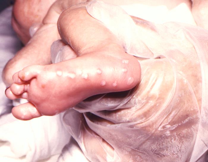 Image depicts the right foot of an infant born with a herpes simplex infection, known as neonatal herpes, or herpes simplex neonatorum, which had manifested itself through the development of maculopapular lesions of the foot’s heal and sole. From Public Health Image Library (PHIL). [2]