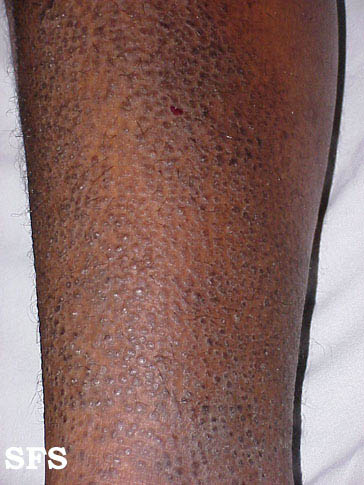 File:Lichen amyloidosus07.jpg