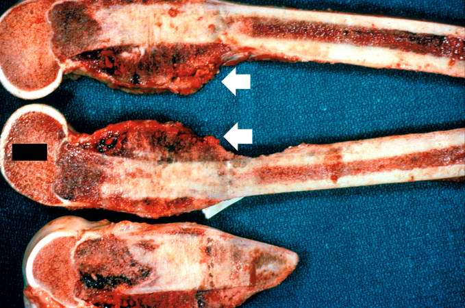 These are cut sections of the distal femur containing the tumor. The periosteal involvement is evident from this picture (arrows).