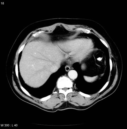 File:Pheochromocytoma CT 2.jpg