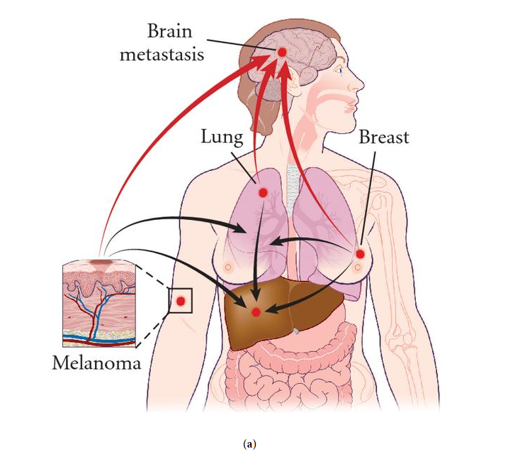File:Schematics of the process of metastasis 1.PNG
