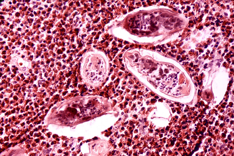 High powered detailed micrograph of Schistosoma parasite eggs in human bladder tissue.