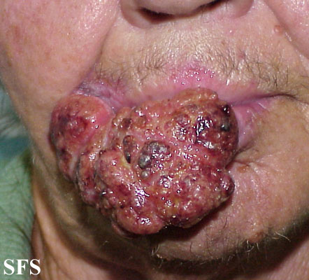 File:Squamous cell carcinoma 12.jpeg