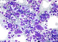 File:197px-Hodgkin lymphoma cytology large.jpg