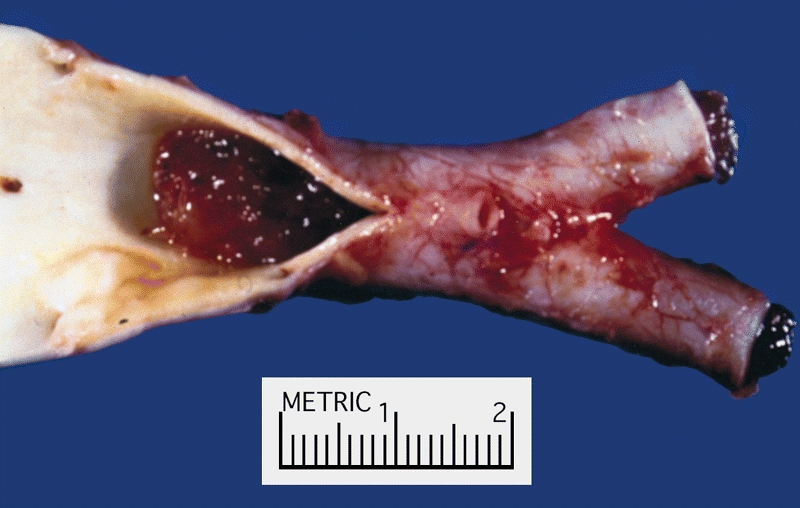 Myxoma Embolus to Iliac Bifurcation: An embolized fragment of the tumor