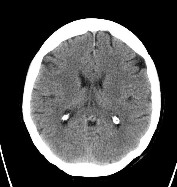 Cerebellopontine angle meningioma[1]
