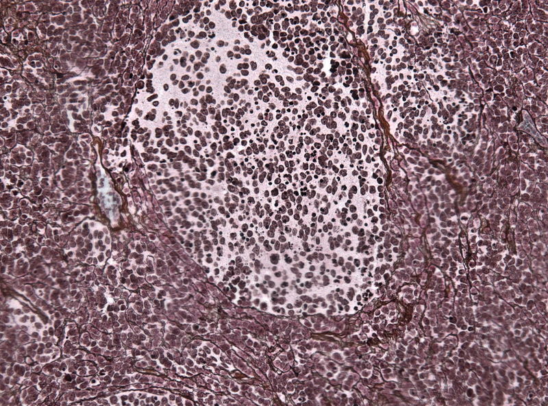 Desmoplastic medulloblastoma on reticulin stain demonstrating pale islands structure[2]