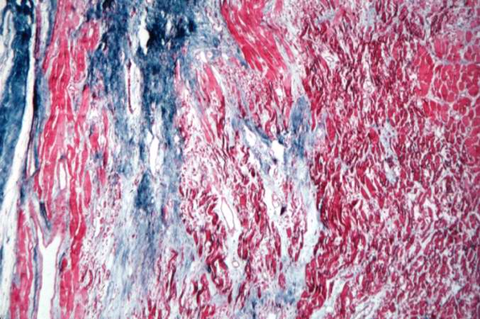 This is a higher-power photomicrograph of a trichrome-stained section of heart containing an old healed MI. The scar tissue (mature fibrous connective tissue) is stained blue.