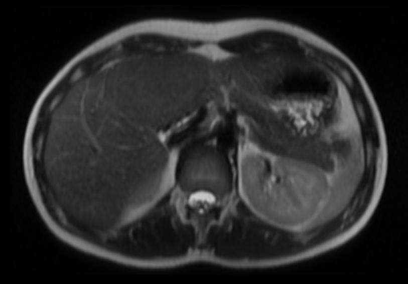 T2 SSFSE: A patient with multiple adenoma