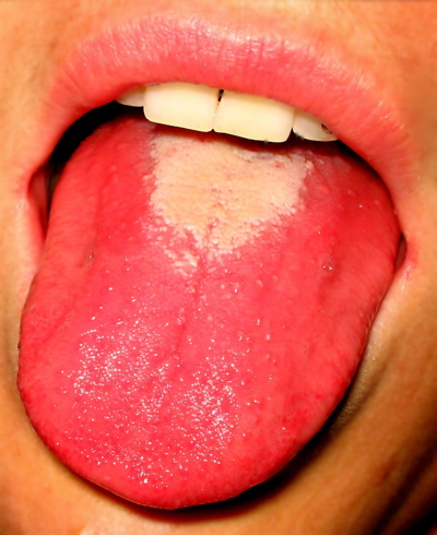 Tongue with a strawberry appearance.