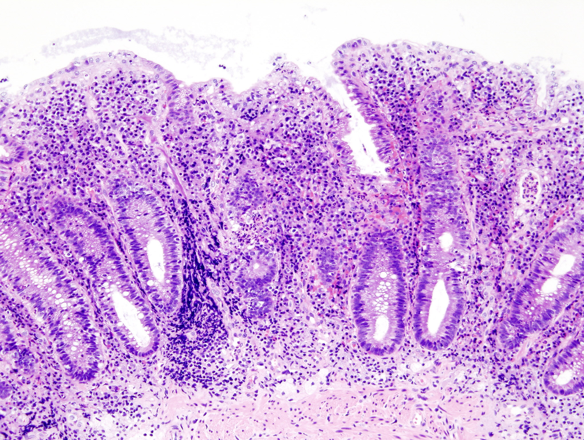 Ulcerative colitis. Biopsy sample (H&E stain) that demonstrates marked lymphocytic infiltration (blue/purple) of the intestinal mucosa and architectural distortion of the crypts. [45]