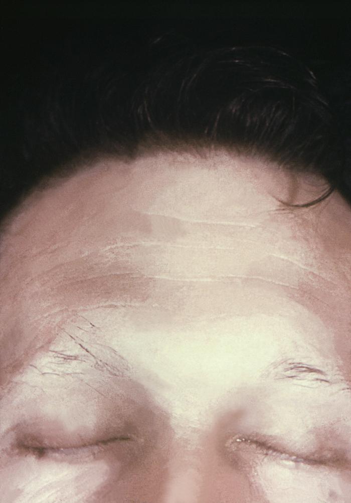 This image depicts the posterior scalp of a patient, who’d presented with what was described as “motheaten” alopecia, due to what was diagnosed as secondary syphilis. The secondary stage of syphilis is characterized by the manifestation of a skin rash and mucous membrane lesions. This stage typically starts with the development of a rash on one or more areas of the body. The rash usually does not cause itching. Rashes associated with secondary syphilis can appear as the chancre is healing or several weeks after the chancre has healed. The characteristic rash of secondary syphilis may appear as rough, red, or reddish brown spots both on the palms of the hands and the bottoms of the feet. However, rashes with a different appearance may occur on other parts of the body, sometimes resembling rashes caused by other diseases. Sometimes rashes associated with secondary syphilis are so faint that they are not noticed. In addition to rashes, symptoms of secondary syphilis may include fever, swollen lymph glands, sore throat, patchy hair loss, headaches, weight loss, muscle aches, and fatigue. The signs and symptoms of secondary syphilis will resolve with or without treatment, but without treatment, the infection will progress to the latent and possibly late stages of disease. Adapted from CDC