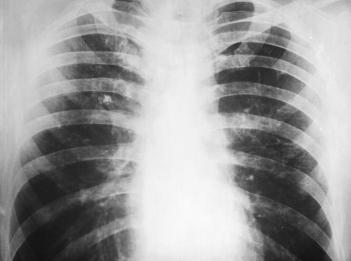 Chest x-ray revealed the presence of a pulmonary infiltrate, which indicated that the patient was suffering from a case of candidiasis. From Public Health Image Library (PHIL). [1]