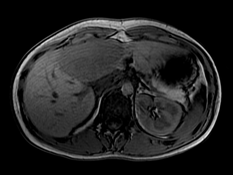 Out of phase: A patient with multiple adenoma