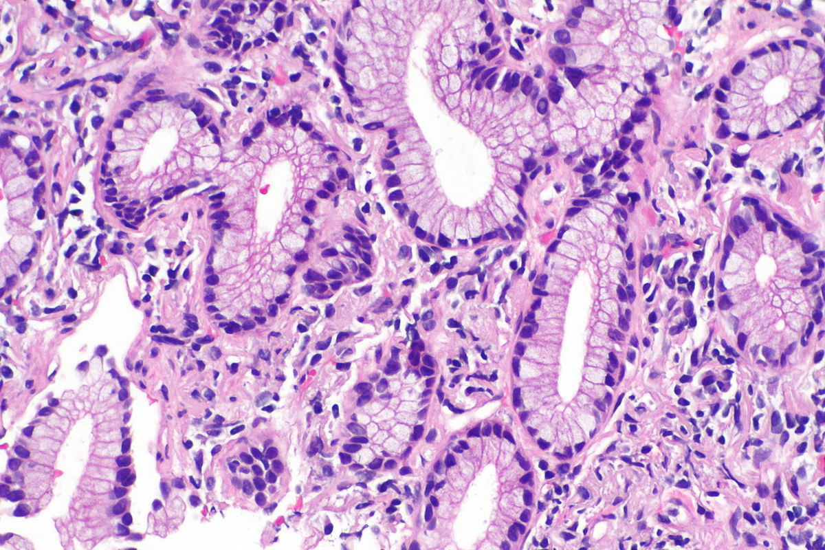 Micrograph showing an adenocarcinoma of the lung (acinar pattern). H&E stain. [7]