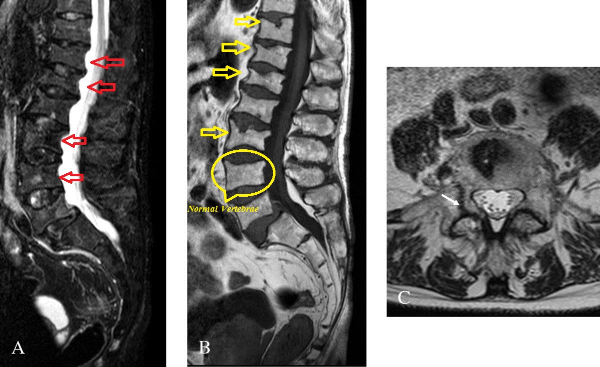 File:Morbus Fabry MRT Osteoporosis.jpg
